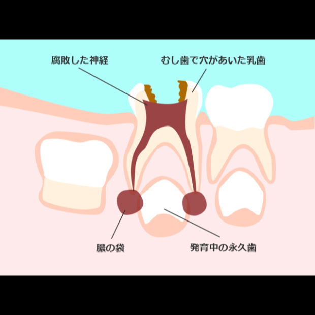 意外と怖い子供の虫歯