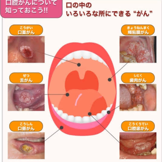 口腔がんってどんな病気？