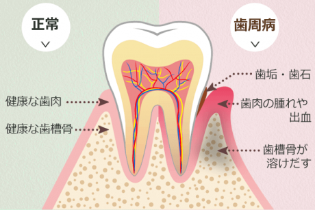 歯周病