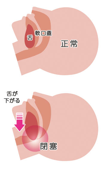 睡眠時無呼吸症候群