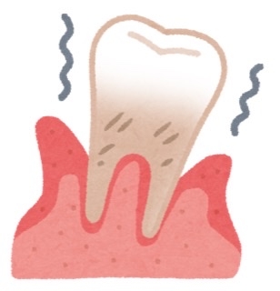 歯周病治療
