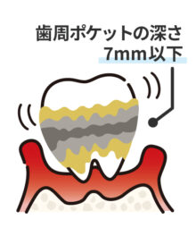 重度の歯周病