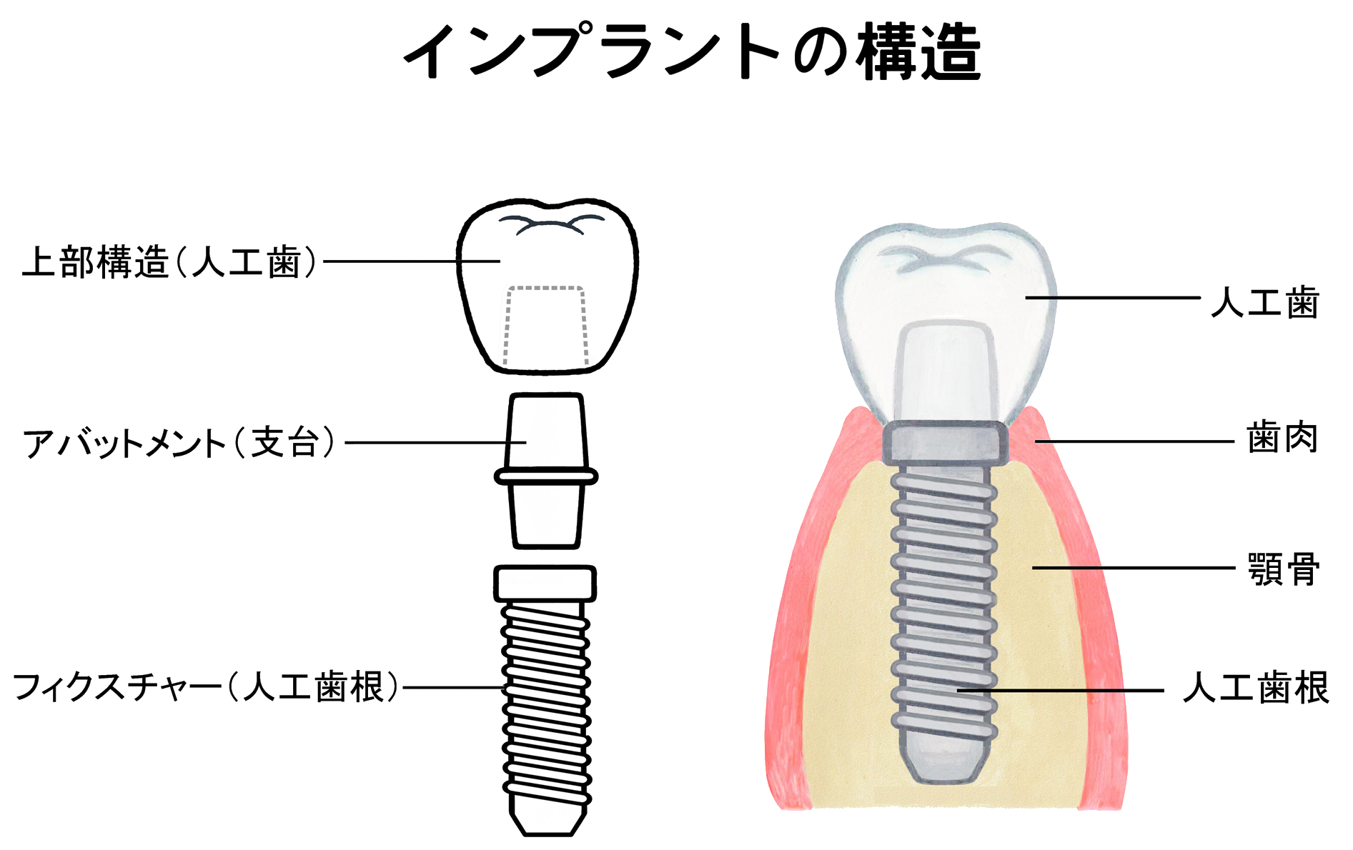 インプラントの構造