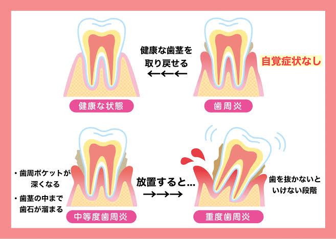 歯周病