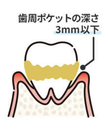 軽度の歯周病