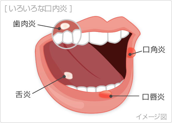 口内炎